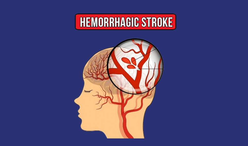 Hemorrhagic Strokes