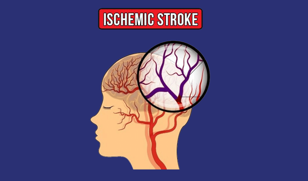 Ischemic Strokes